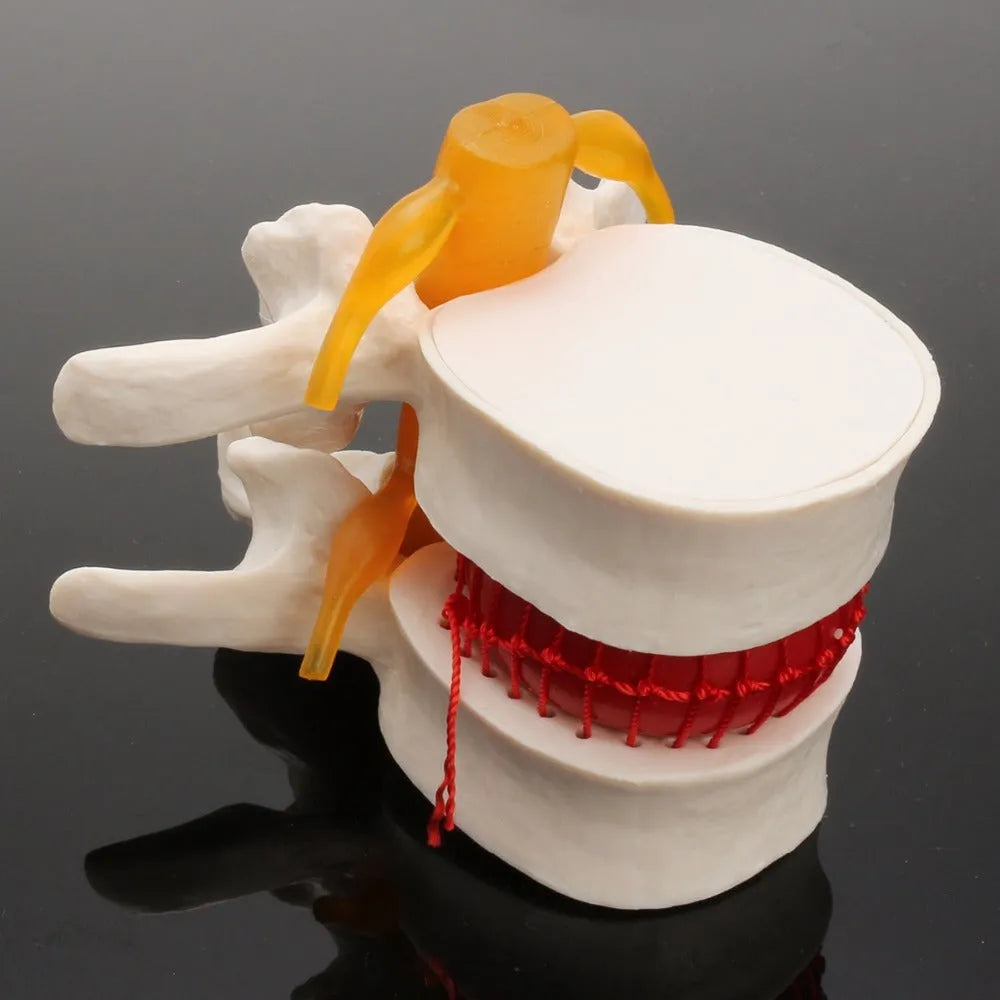 White PVC medical model showing lumbar intervertebral disc herniation anatomy for teaching
