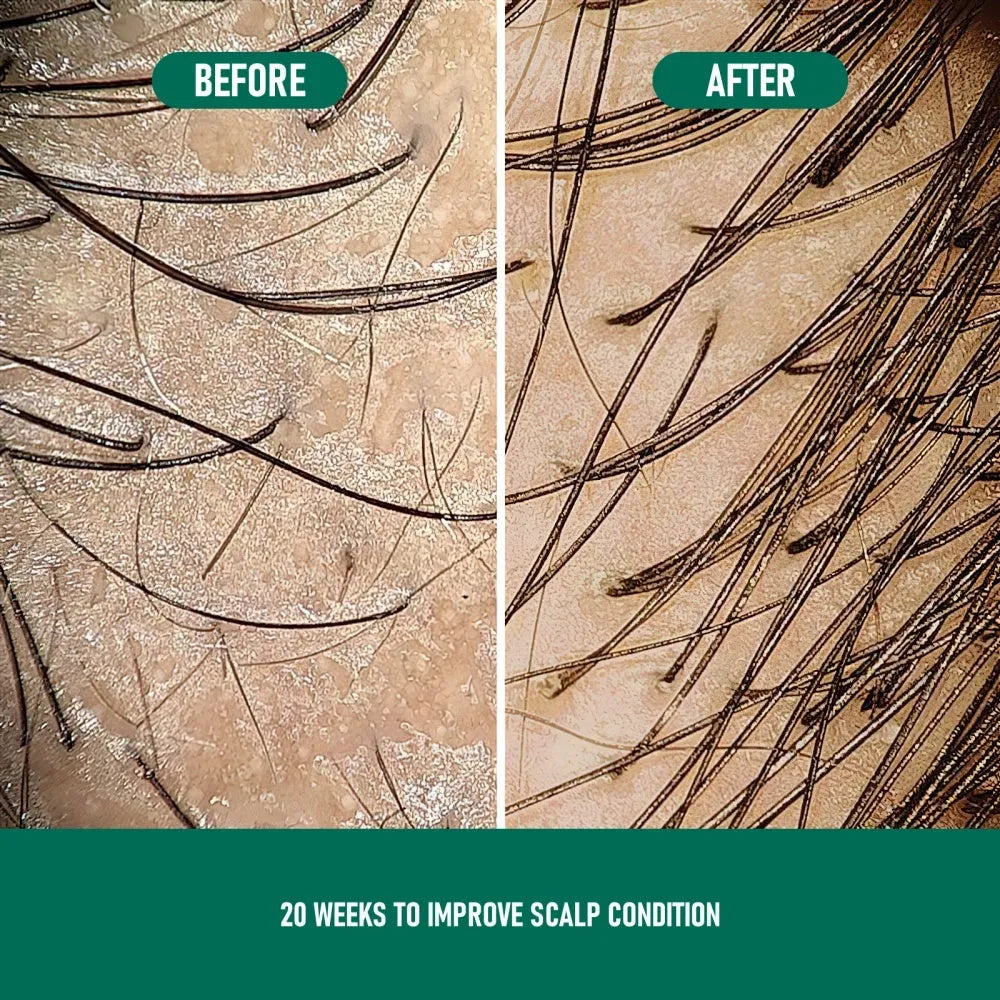 CH004 Minoxidil 5% Anti-Hair Loss Mousse 60ml aerosol canister with applicator nozzle