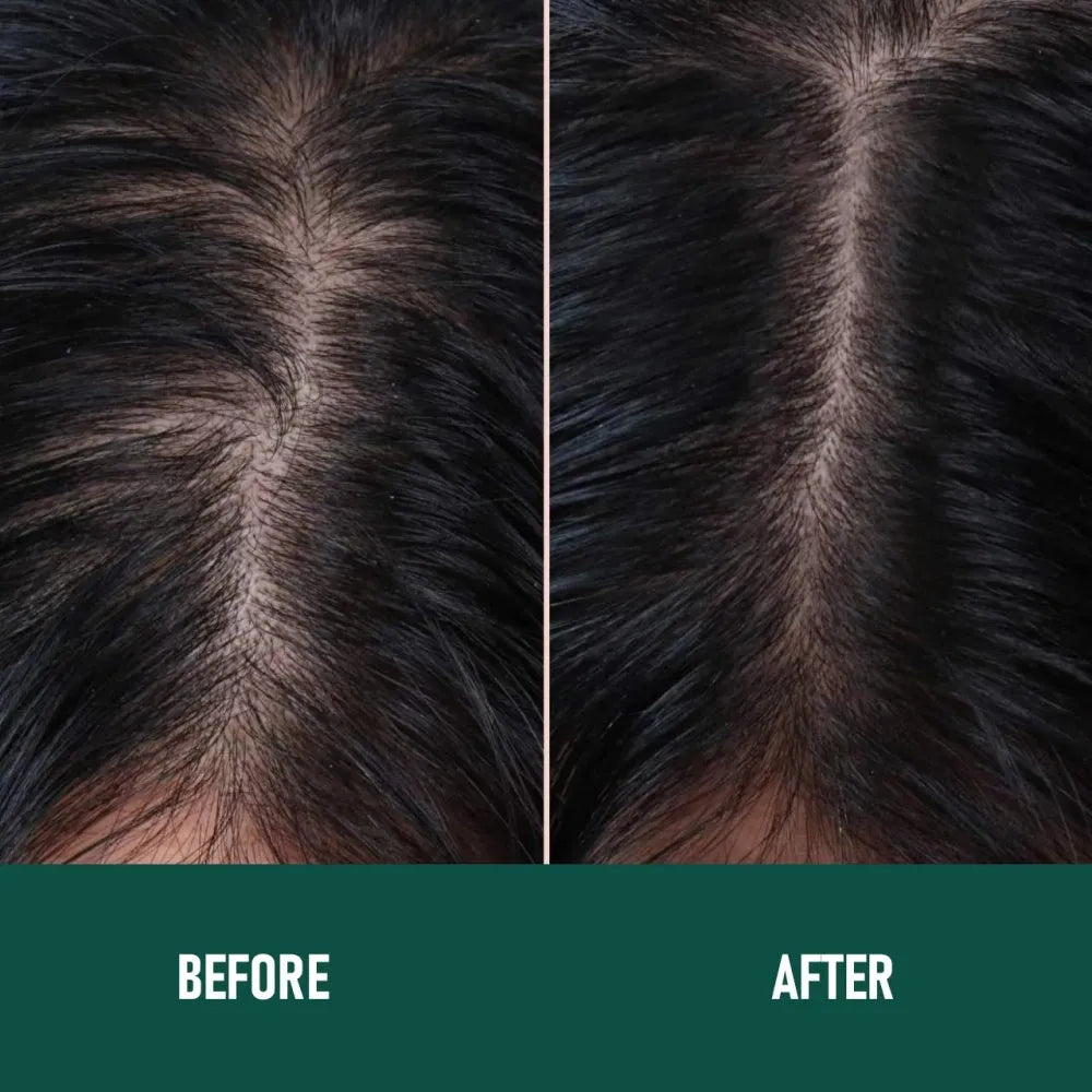 CH004 Minoxidil 5% Anti-Hair Loss Mousse 60ml aerosol canister with applicator nozzle