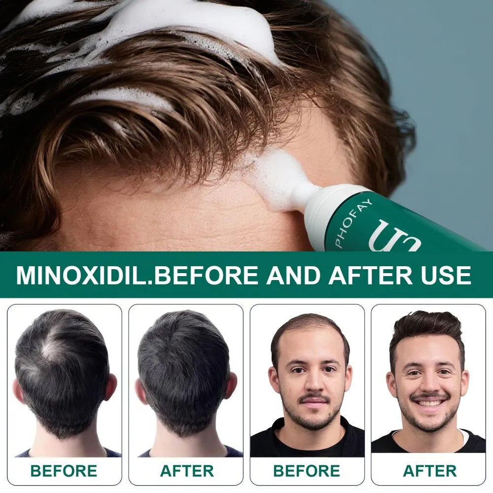 CH004 Minoxidil 5% Anti-Hair Loss Mousse 60ml aerosol canister with applicator nozzle