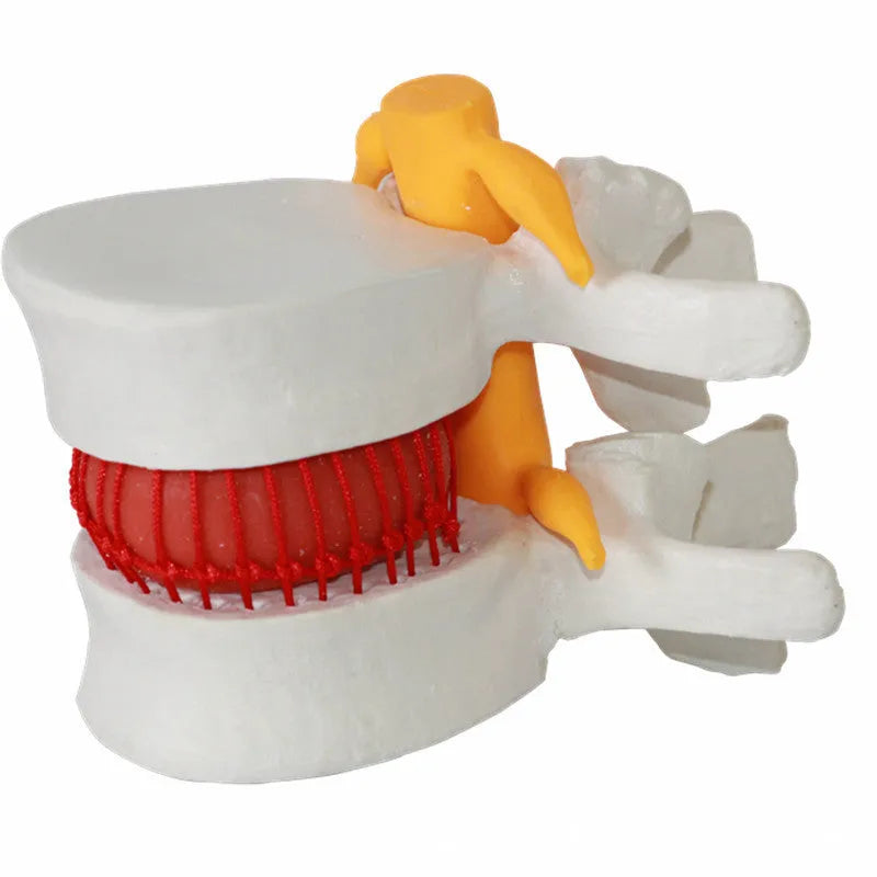 White PVC medical model showing lumbar intervertebral disc herniation anatomy for teaching