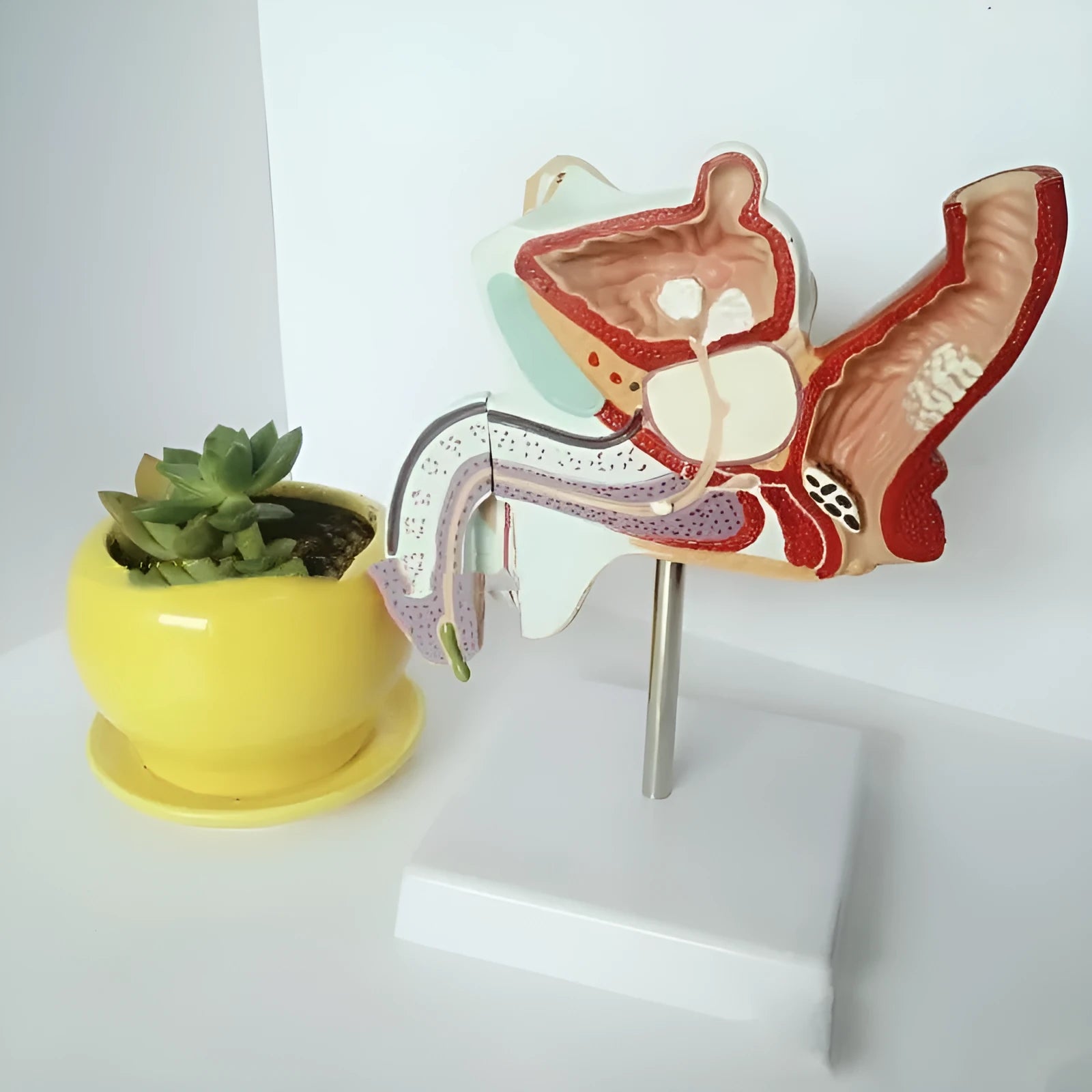 Anatomical model of male reproductive system showing prostate hyperplasia and other pathologies
