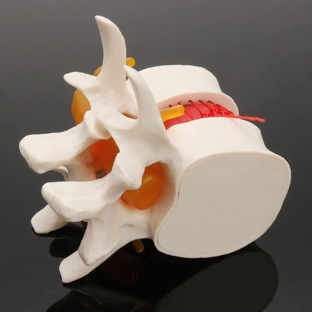 White PVC medical model showing lumbar intervertebral disc herniation anatomy for teaching