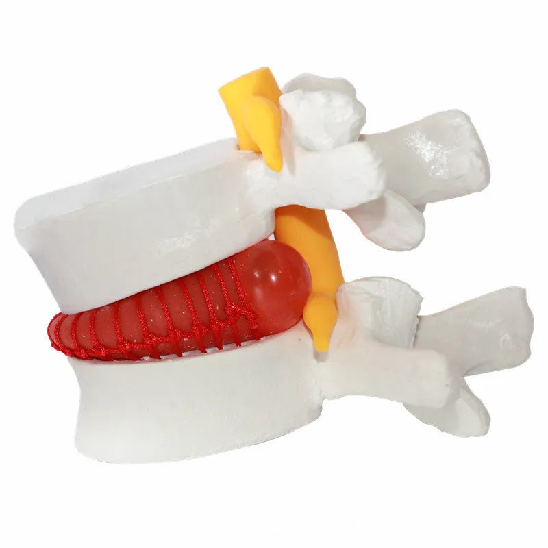 White PVC medical model showing lumbar intervertebral disc herniation anatomy for teaching