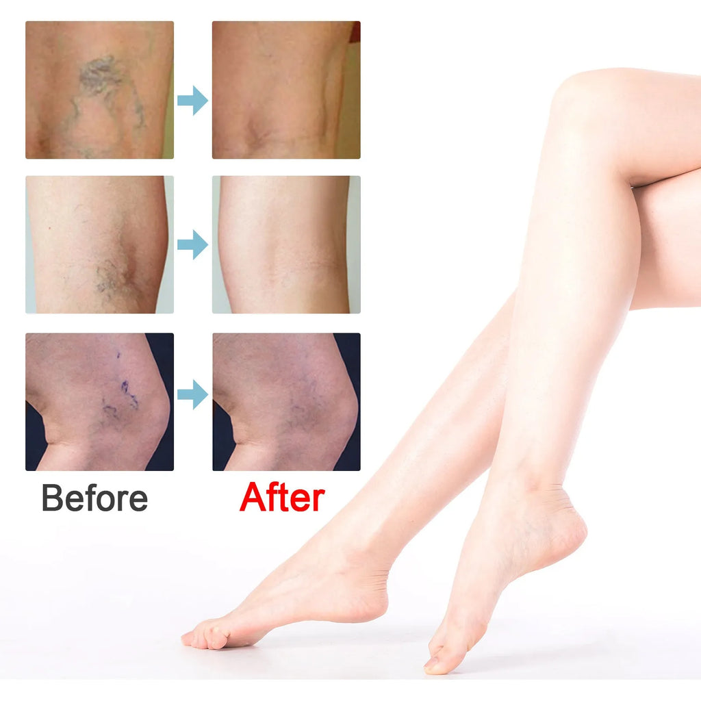 20g tube of vein repair cream for leg vein relief and green tendon bulge reduction.