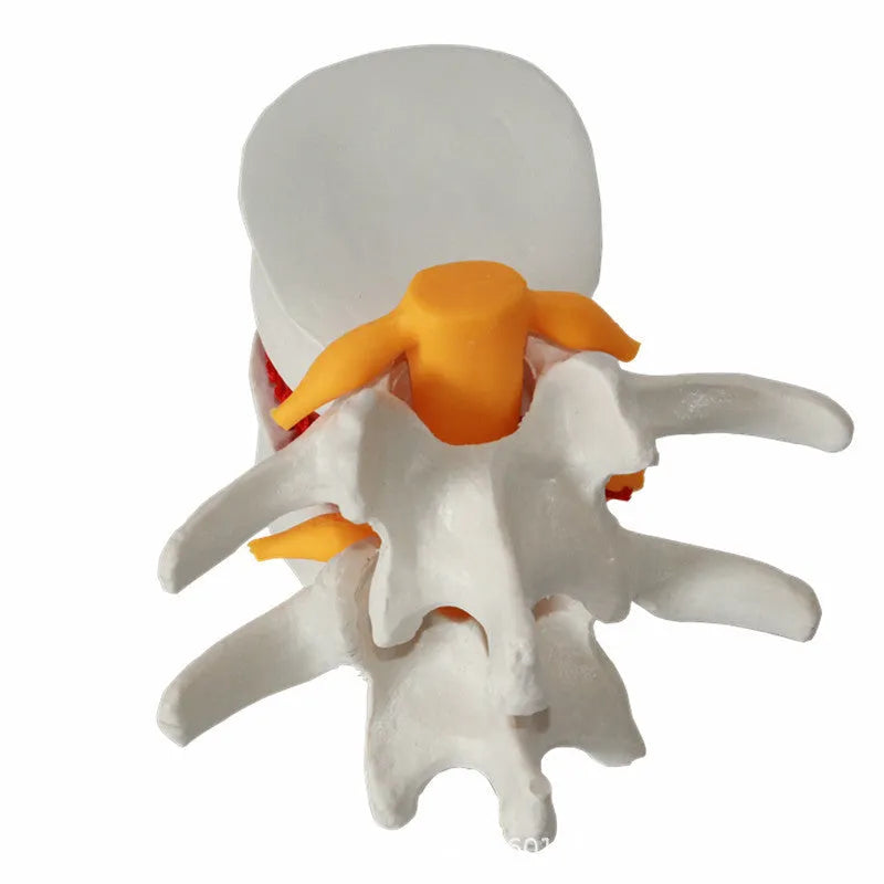White PVC medical model showing lumbar intervertebral disc herniation anatomy for teaching