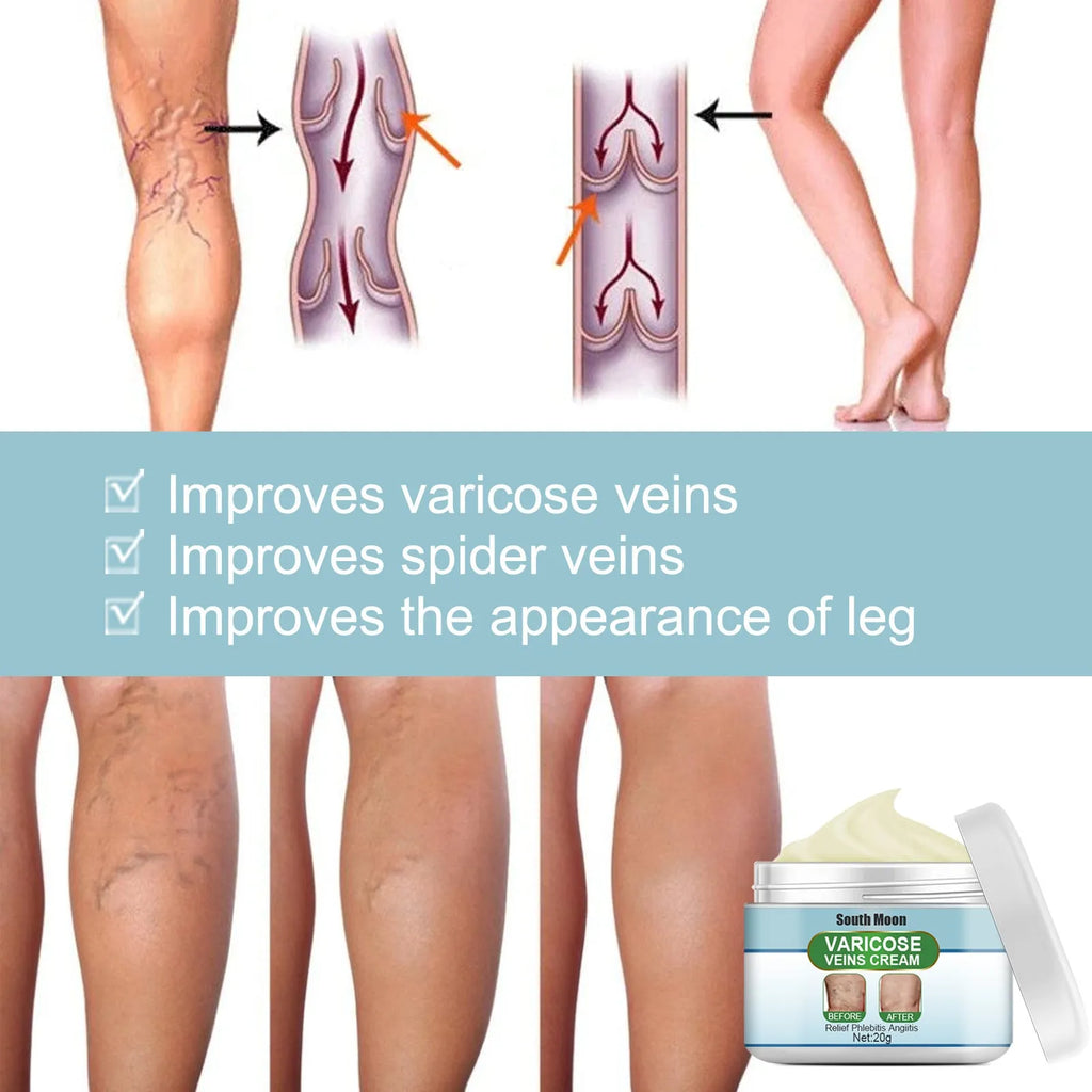 20g tube of vein repair cream for leg vein relief and green tendon bulge reduction.