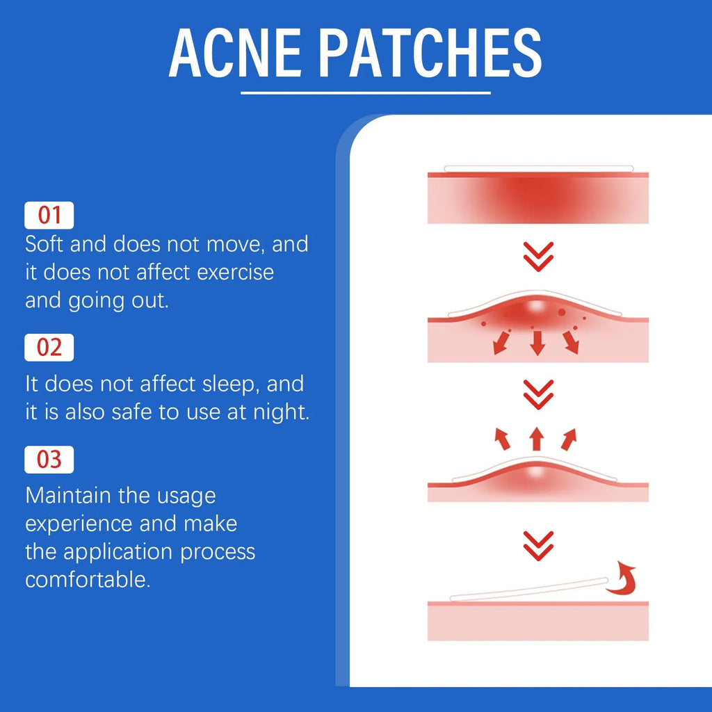 Pack of 216 acne patches for facial care with Tea Tree Oil and Vitamin E