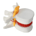 White PVC medical model showing lumbar intervertebral disc herniation anatomy for teaching