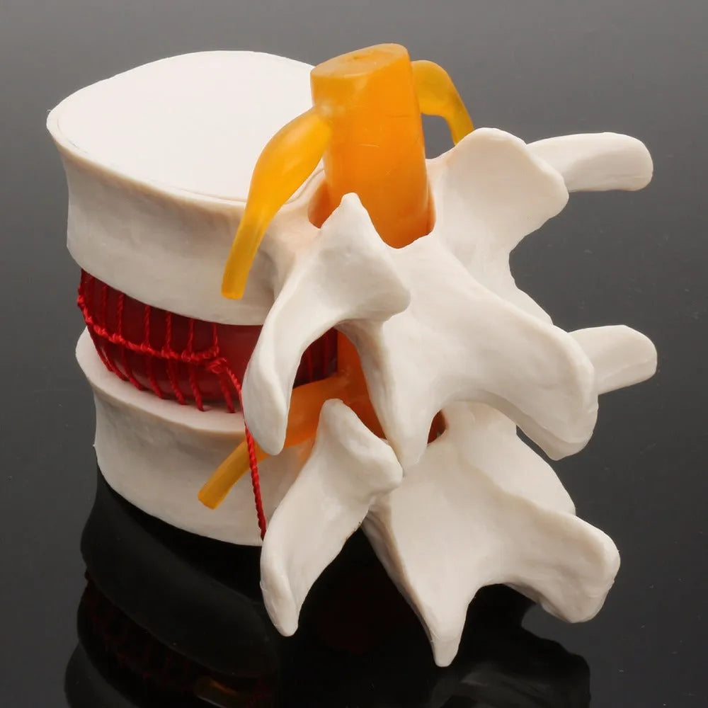 White PVC medical model showing lumbar intervertebral disc herniation anatomy for teaching