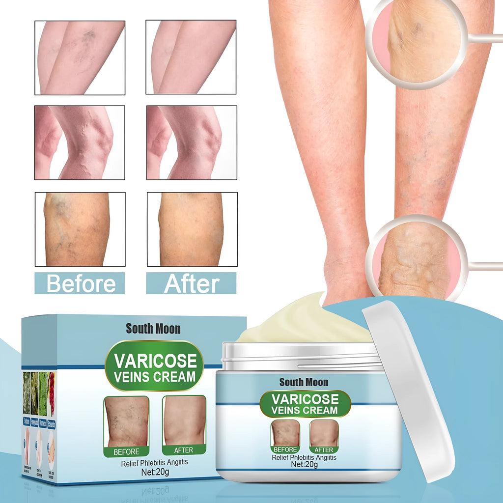 20g tube of vein repair cream for leg vein relief and green tendon bulge reduction.