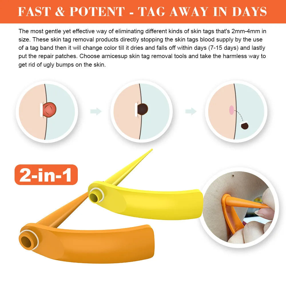 Orange mole removal tool kit with wart remover device, rubber rings, alcohol swabs, and repair sticker