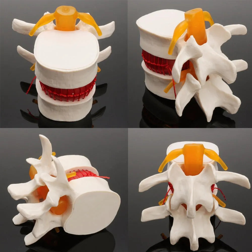 White PVC medical model showing lumbar intervertebral disc herniation anatomy for teaching