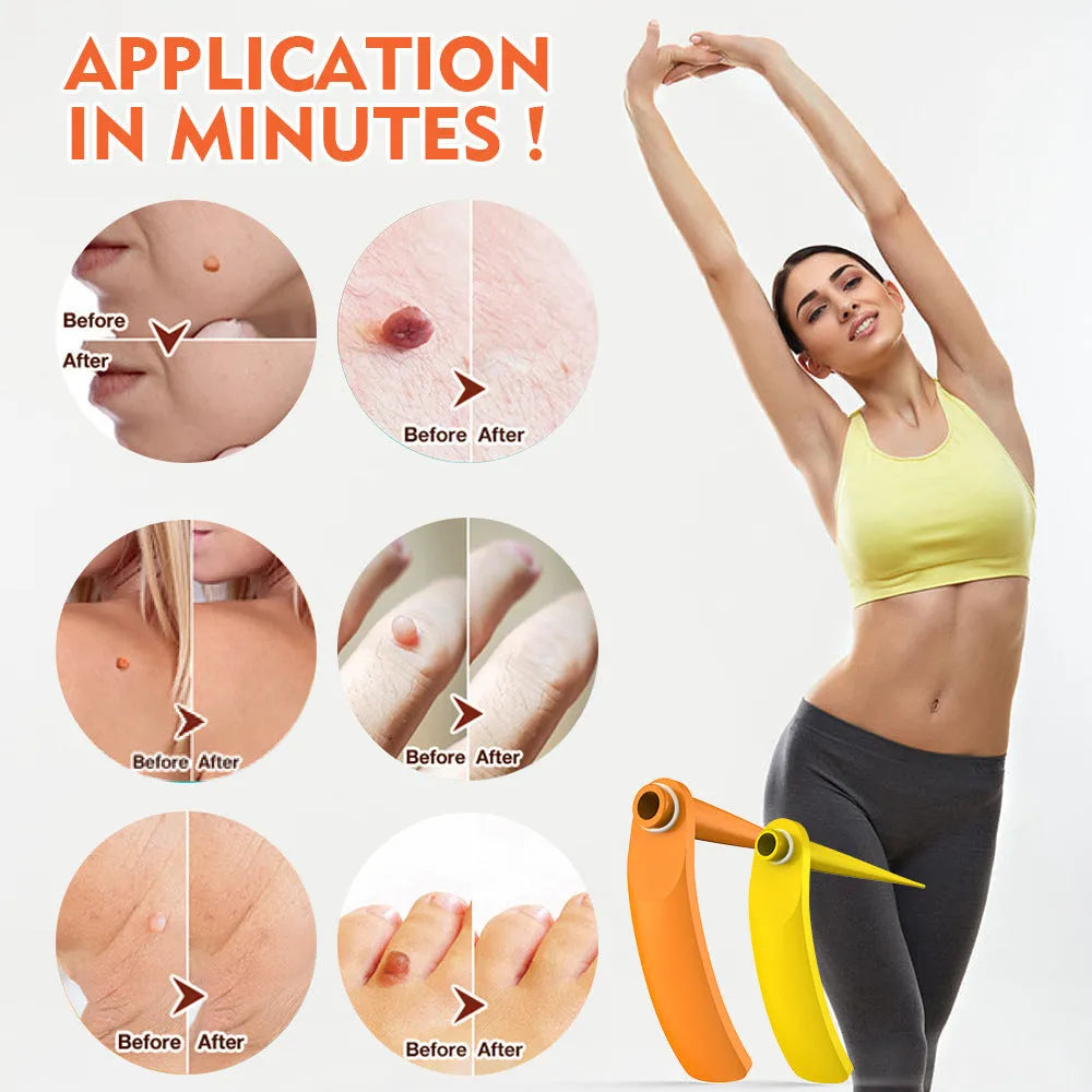 Orange mole removal tool kit with wart remover device, rubber rings, alcohol swabs, and repair sticker