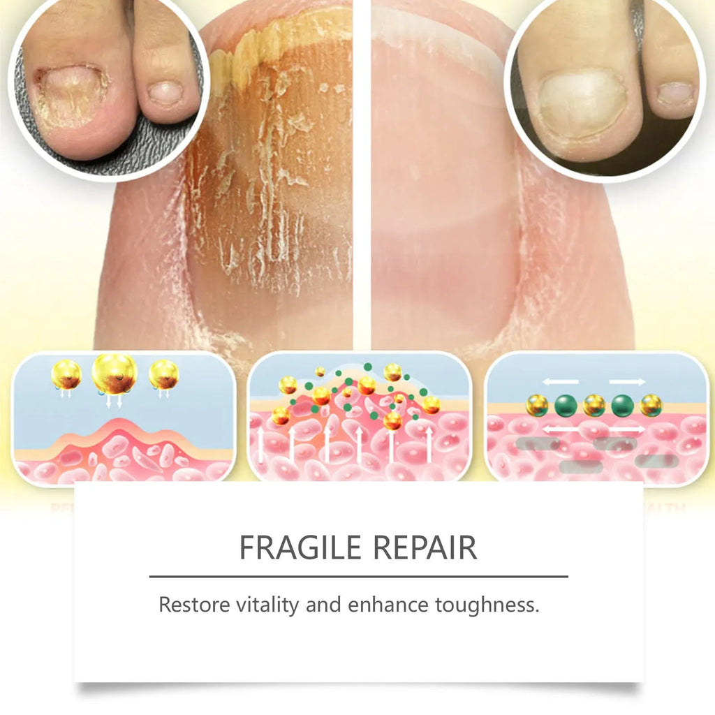 50ml bottle of nail care solution with bee venom and peppermint oil for nail fungus treatment