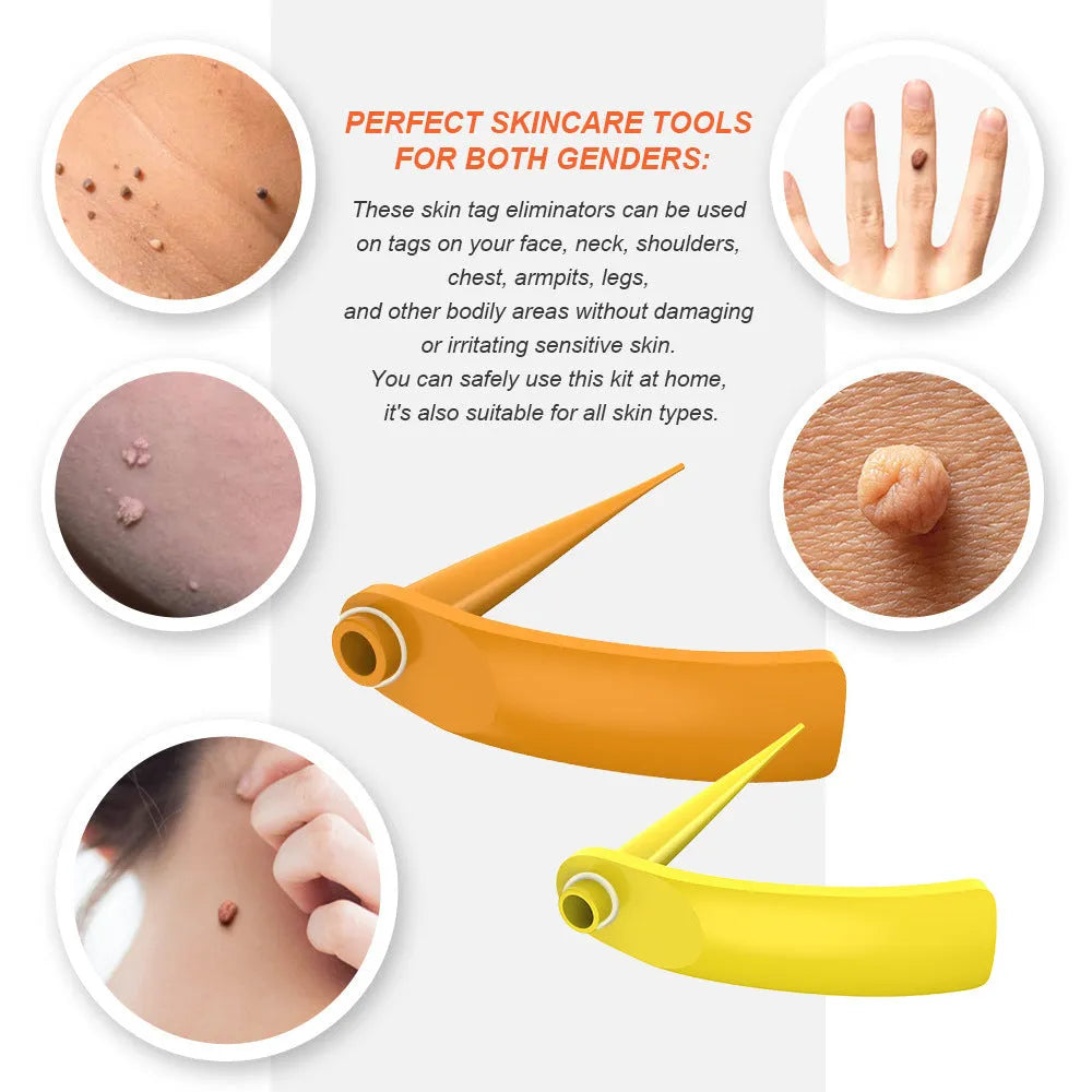 Orange mole removal tool kit with wart remover device, rubber rings, alcohol swabs, and repair sticker